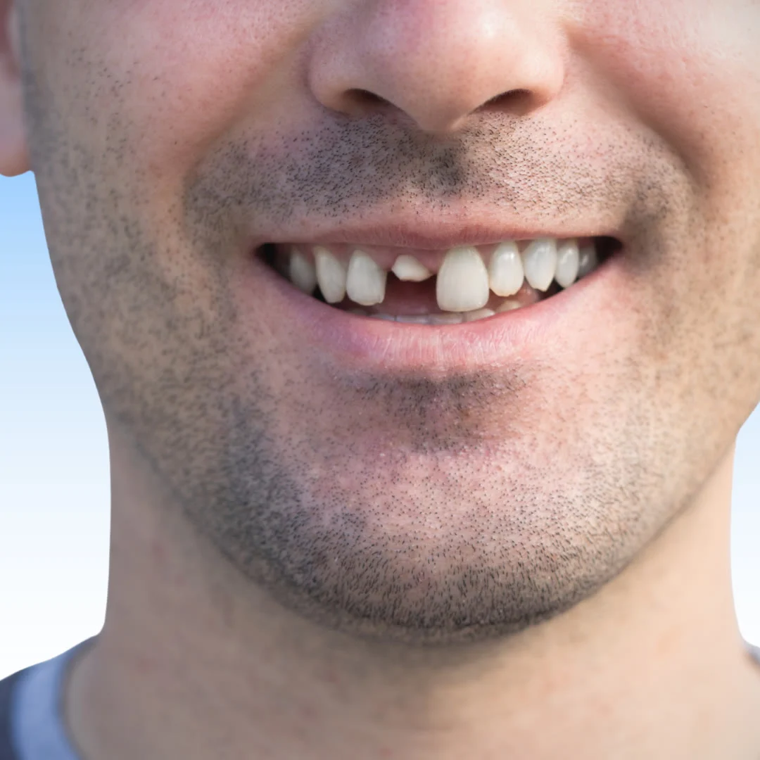 Cracked Tooth Treatment — Ocean Endodontics, San Francisco