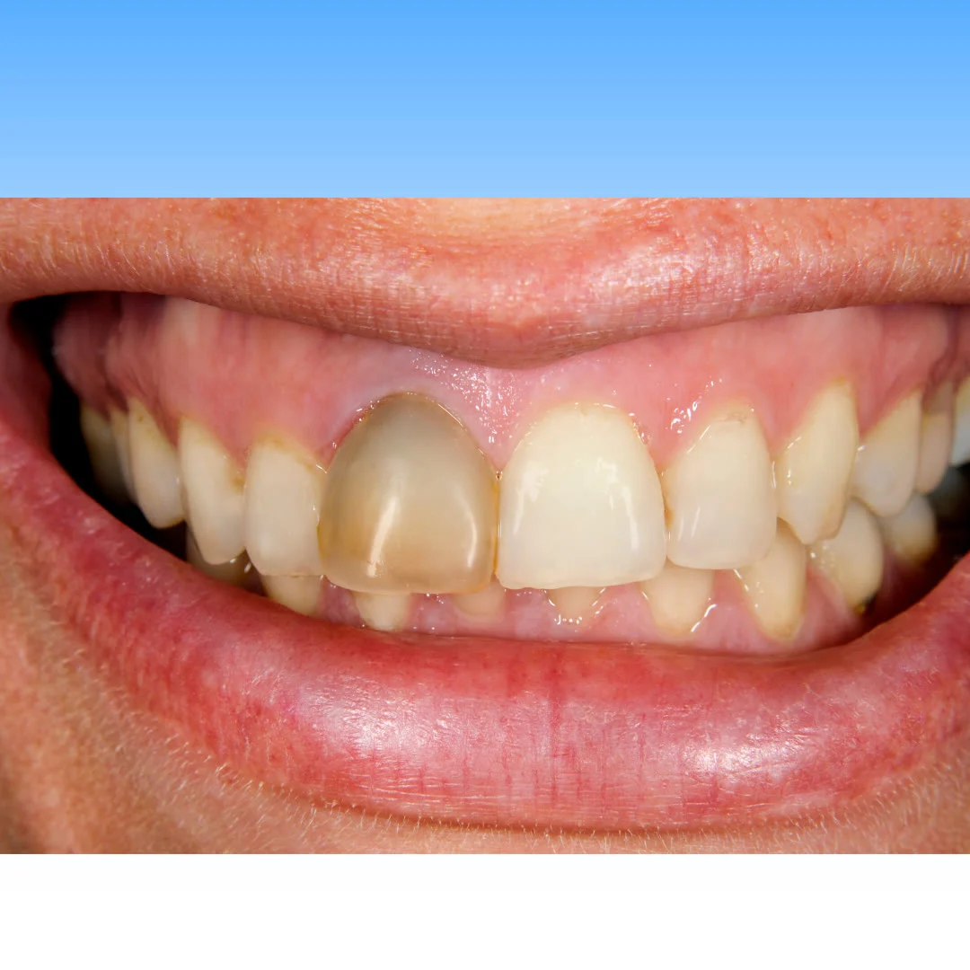 Internal Bleaching — Ocean Endodontics, San Francisco