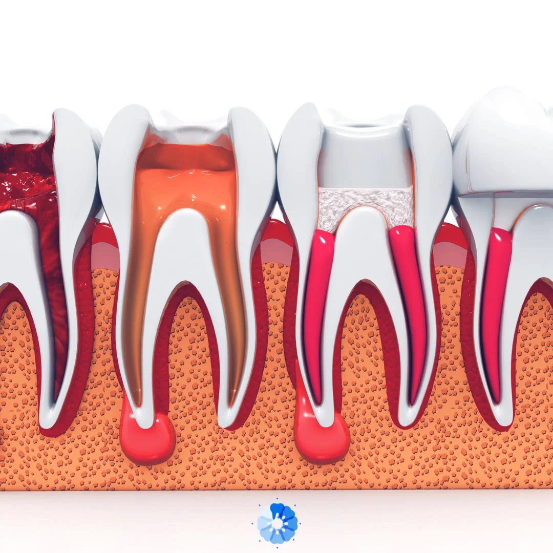 Endodontic Retreatment — Ocean Endodontics, San Francisco