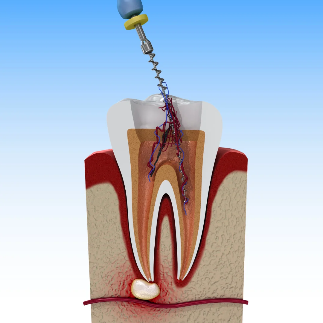 Root Canal Therapy — Ocean Endodontics, San Francisco